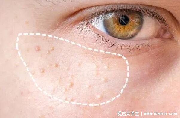 粟丘疹是什么样的图片，脸上长针头大小的白色丘疹(不影响健康)