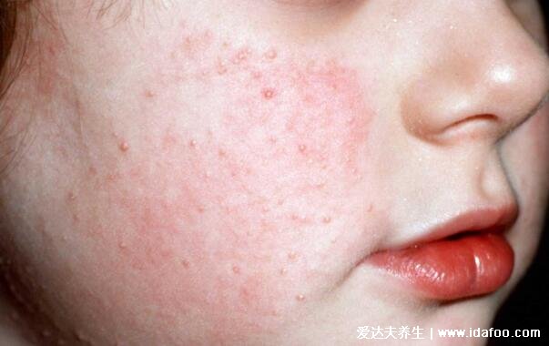 粟丘疹是什么样的图片，脸上长针头大小的白色丘疹(不影响健康)