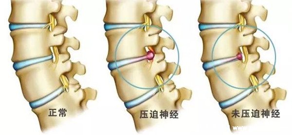 肾疼和腰疼的区别图解图片，肾疼在侧腹腰疼在背部