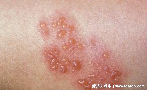 水泡和疱疹的区别图片，水泡疹长什么样图片(4种类型)