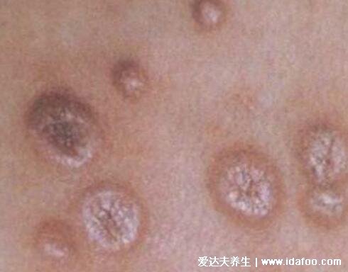 男性下面感染早期症状图片，梅毒/尖锐湿疣/生殖器疱疹/传染性软疣
