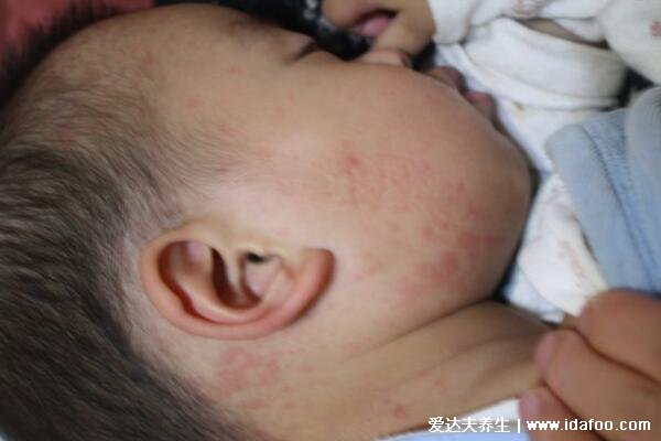 高烧退后的疹子图片，从脖子蔓延至全身的玫瑰色丘疹1-2天消失