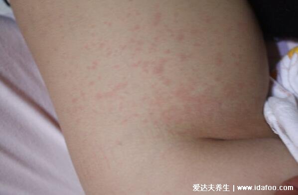 高烧退后的疹子图片，从脖子蔓延至全身的玫瑰色丘疹1-2天消失