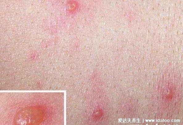 刚长的水痘是什么样子图片，水痘的7天演变过程图片