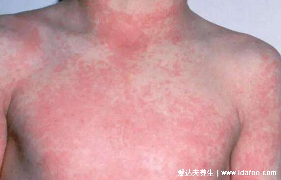 儿童猩红热皮疹图片，发热全身长鸡皮样的鲜红疹要注意(7天左右消退)