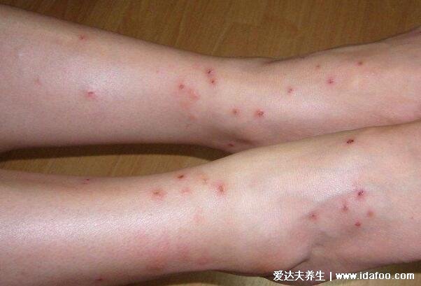 腿上突然长了十来个红坨很痒，皮炎/湿疹/荨麻疹/被跳蚤咬了(图片)