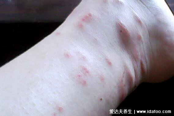 腿上突然长了十来个红坨很痒，皮炎/湿疹/荨麻疹/被跳蚤咬了(图片)