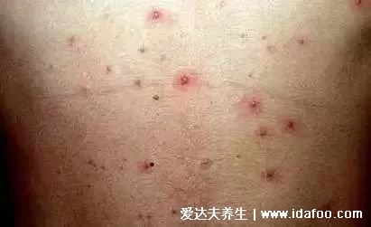 怎么判断是不是水痘图片，附7天演变过程(红色斑点类似蚊子包)