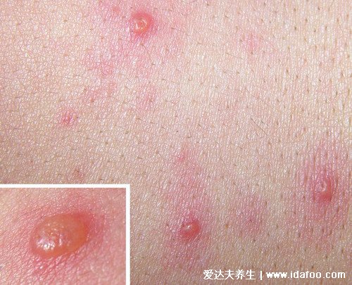 怎么判断是不是水痘图片，附7天演变过程(红色斑点类似蚊子包)