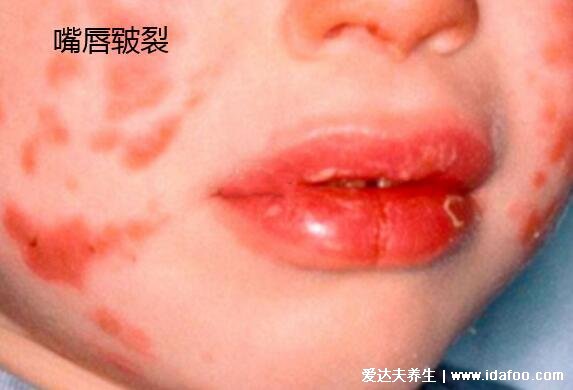 川崎病嘴干裂图片，口唇皲裂出血/有草莓舌