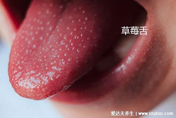 川崎病嘴干裂图片，口唇皲裂出血/有草莓舌