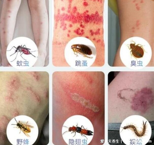 图解各种虫咬症状，虱子/跳蚤/蜱虫等7种虫咬图片合集