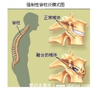 右后背痛病情对照图，需警惕四种病（女性更易得风湿）