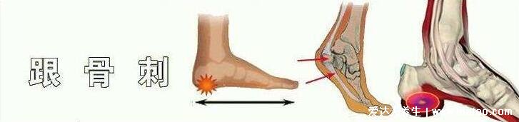 女性足底筋膜炎4个痛点图片，跟骨内上方最严重(3种止疼方法)
