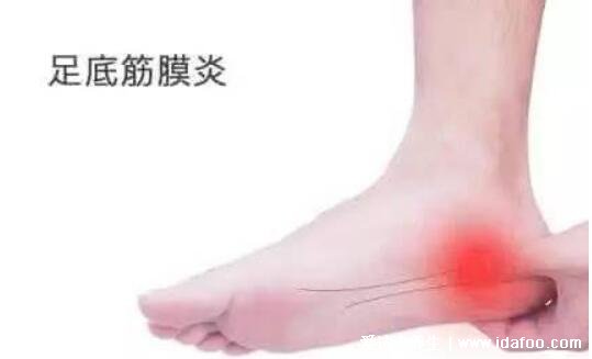 女性足底筋膜炎4个痛点图片，跟骨内上方最严重(3种止疼方法)