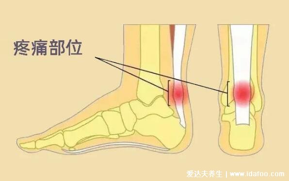 脚踝各个部位疼痛图解，脚踝后侧可能是跟腱炎(附脚底疼痛部位图解)