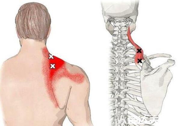 左后背疼痛位置图详解，警惕左背放射至左肩左手臂内侧疼(心肌梗塞)