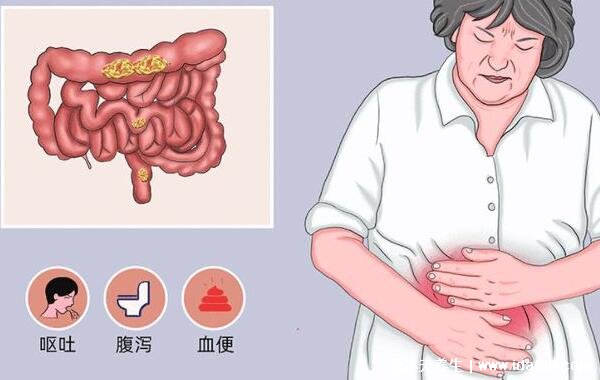 肠梗阻疼痛部位图片，肚脐周围疼/腹胀不排气不排便(死亡率10%)
