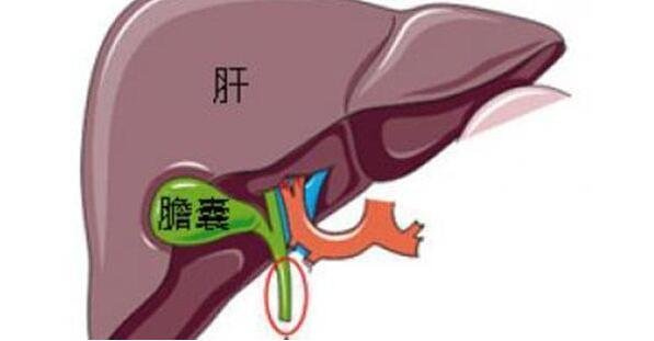 胆囊疼的真人位置图，右上腹向右肩背放射痛注意和肝痛区分