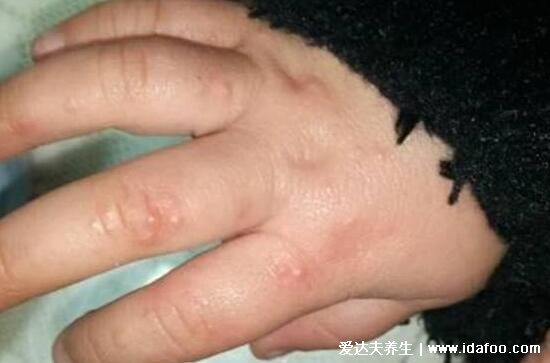 手足水泡型疱疹图片，汗疱疹症状手足长小水泡伴随剧烈瘙痒