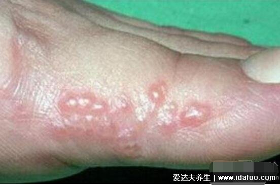手足水泡型疱疹图片，汗疱疹症状手足长小水泡伴随剧烈瘙痒