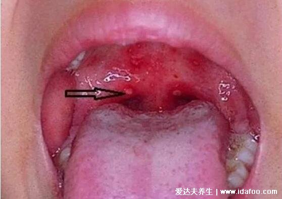 小儿疱疹性咽峡炎最早期图片，只在口腔/咽颊有灰白色疱疹(手足口病相似)