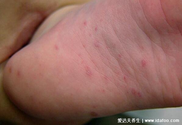 大人手足口什么样子图片，感冒症状后长小红点两天发展成疱疹