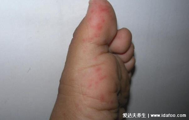 大人手足口什么样子图片，感冒症状后长小红点两天发展成疱疹