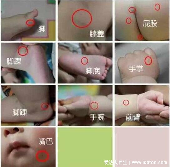 小儿手足口发展过程演示图，出疱疹顺序图片及症状表现