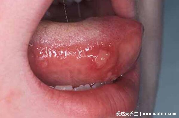 口足手病嘴巴疱疹图片，容易形成溃疡警惕重症型手足口病