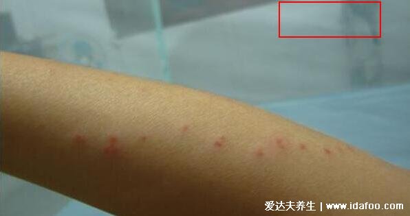 过敏和疹子的区别图片，湿疹/荨麻疹/痱子/过敏性皮炎的区别图片