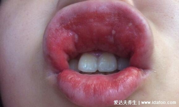 小孩口腔上颚有红点图片，口腔溃疡/疱疹性咽峡炎/口腔炎/手足口病合集