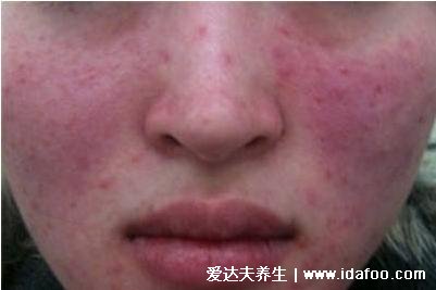 怎样判断过敏还是湿疹，过敏与湿疹的区别图片（过敏是脸上）