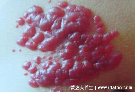 血管瘤最初小红点图片，最开始的症状不起眼(常被误认为朱砂痣)