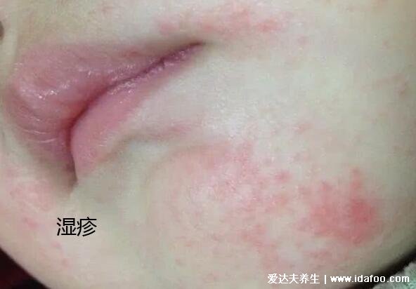 湿疹与热疹的区别图片，湿疹的红色丘疹会融合成片有渗出液
