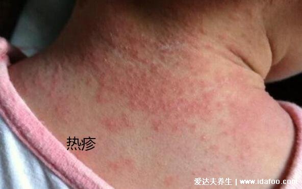 湿疹与热疹的区别图片，湿疹的红色丘疹会融合成片有渗出液