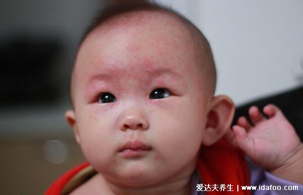 幼儿急疹图片初期症状图，高烧4天后全身长粉色斑点样皮疹(家长必看)