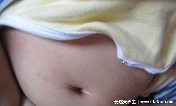 幼儿急疹图片初期症状图，高烧4天后全身长粉色斑点样皮疹(家长必看)