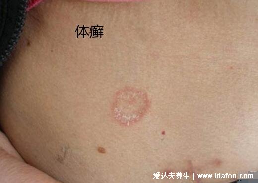 体癣图片初期症状，湿疹和癣的区别图(体癣会传染)