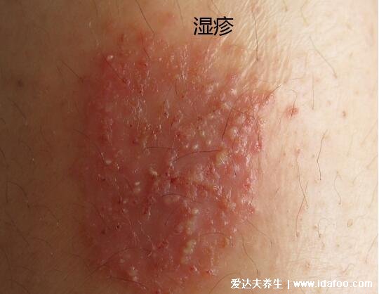 体癣图片初期症状，湿疹和癣的区别图(体癣会传染)