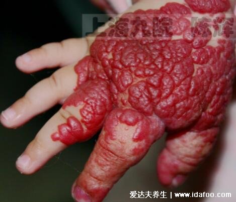 红色血管瘤是什么样的图片，宝宝有红色斑点或肉瘤就要注意了