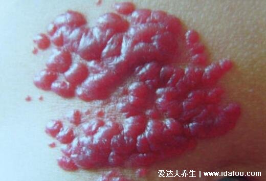 红色血管瘤是什么样的图片，宝宝有红色斑点或肉瘤就要注意了