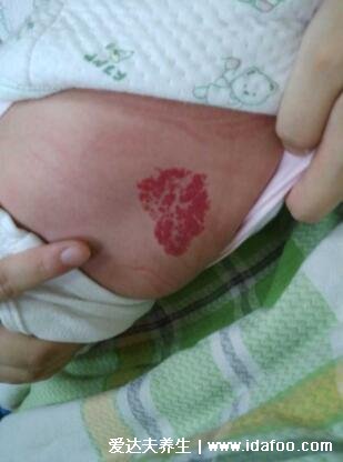 宝宝背上血管瘤图片，身体各个部位的血管瘤图片