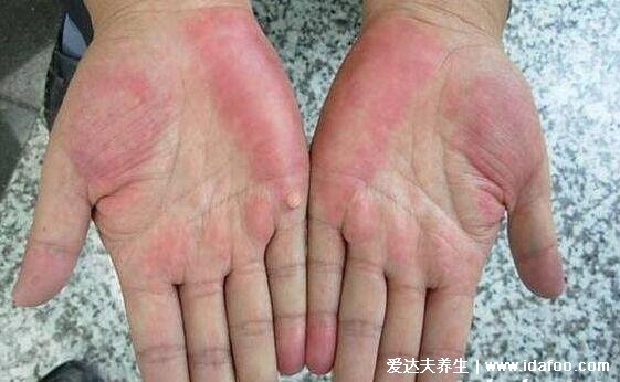 肝不好的手掌图片是什么样的，4种肝受损的手掌特征(警惕肝掌)