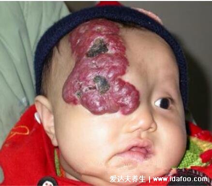 两个月婴儿血管瘤图片，要警惕眼睛和喉咙也会长