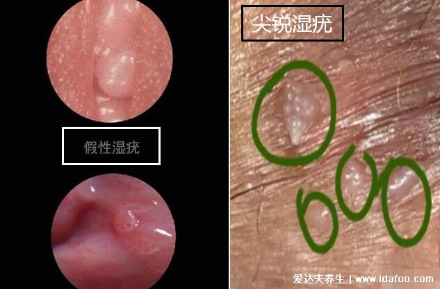 女性假疣和真疣的区别图，教你一眼分辨珍珠疹和尖锐湿疣