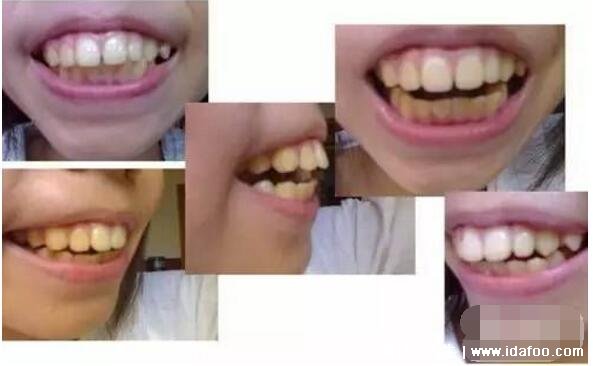 两种类型的龅牙图片，龅牙的形成原因及治疗方法(骨性龅牙最丑)