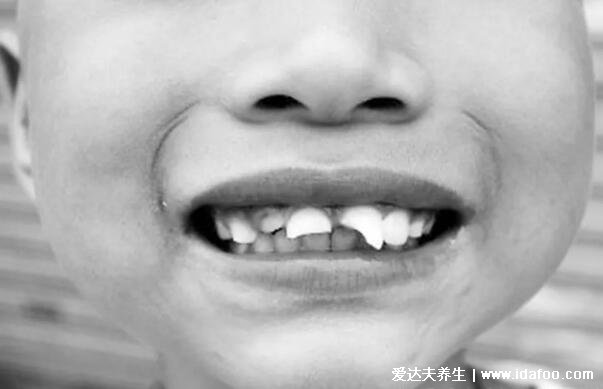 两种类型的龅牙图片，龅牙的形成原因及治疗方法(骨性龅牙最丑)