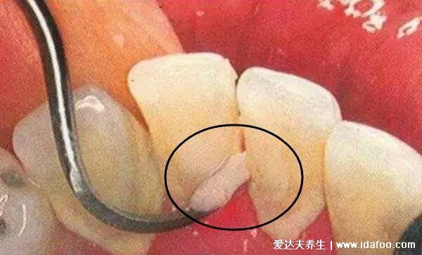 牙结石图片及形成原因，牙结石可以自己抠掉吗(不行)
