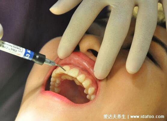 早期牙龈炎图片症状及治疗方法，牙龈出血的时候需警惕(5大症状)